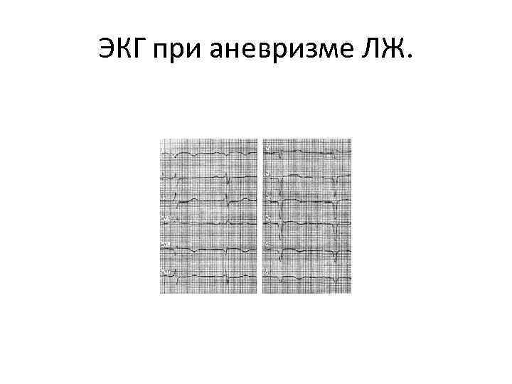 ЭКГ при аневризме ЛЖ. 