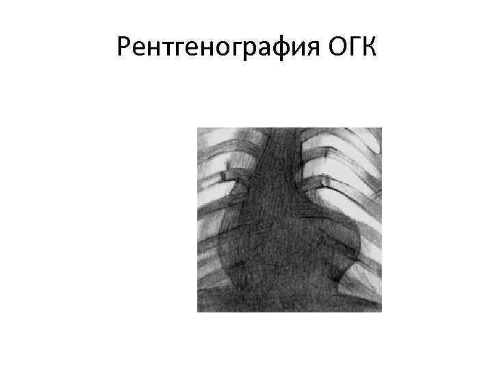 Рентгенография ОГК 
