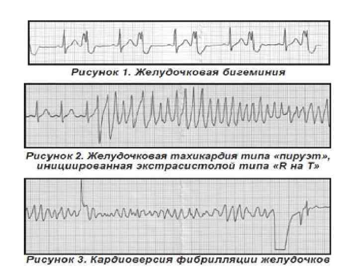 Нарушение ритма по типу бигеминии карта вызова