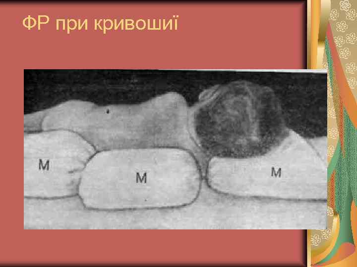 ФР при кривошиї 