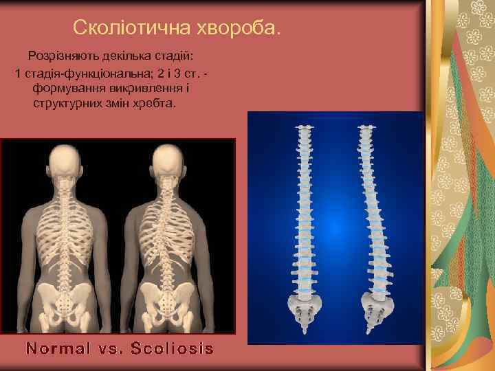 Сколіотична хвороба. Розрізняють декілька стадій: 1 стадія-функціональна; 2 і 3 ст. формування викривлення і