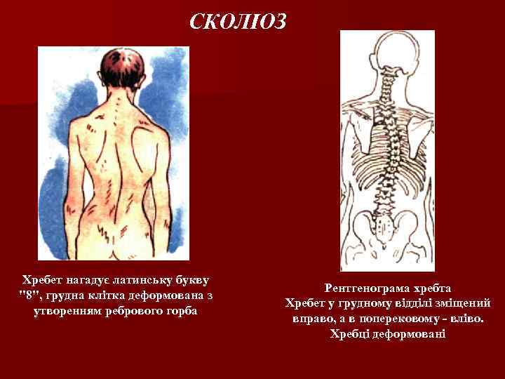 СКОЛІОЗ Хребет нагадує латинську букву "8", грудна клітка деформована з утворенням ребрового горба Рентгенограма