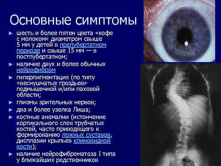 Основные симптомы ► ► ► ► шесть и более пятен цвета «кофе с молоком»