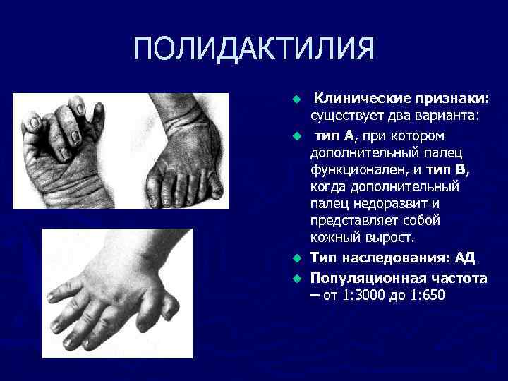 ПОЛИДАКТИЛИЯ u u Клинические признаки: существует два варианта: тип А, при котором дополнительный палец