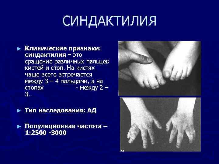 СИНДАКТИЛИЯ ► Клинические признаки: синдактилия – это сращение различных пальцев кистей и стоп. На