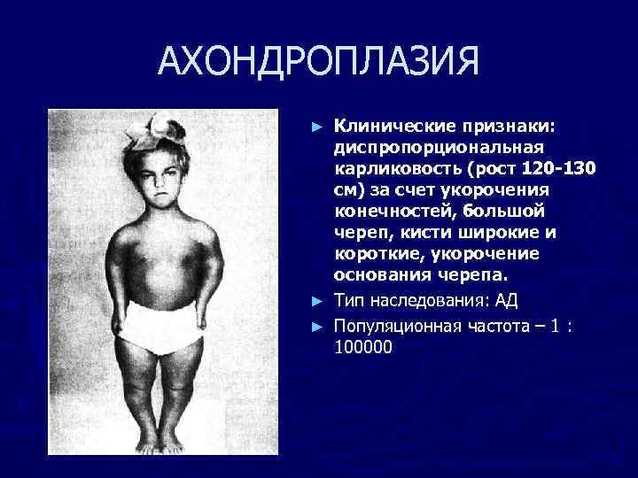 АХОНДРОПЛАЗИЯ Клинические признаки: диспропорциональная карликовость (рост 120 -130 см) за счет укорочения конечностей, большой