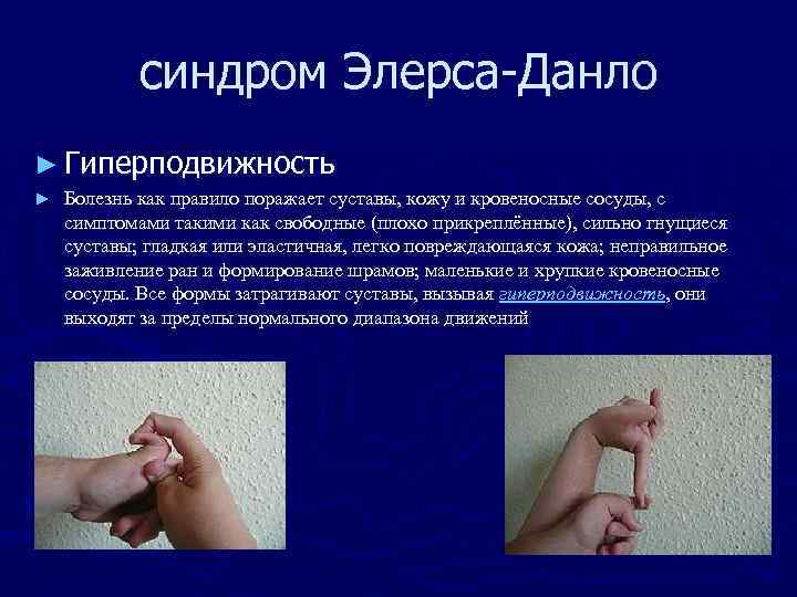 синдром Элерса-Данло ► Гиперподвижность ► Болезнь как правило поражает суставы, кожу и кровеносные сосуды,