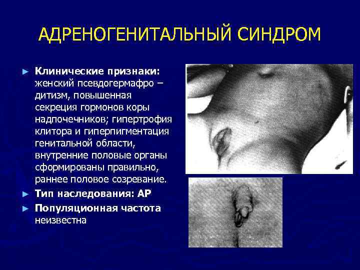 АДРЕНОГЕНИТАЛЬНЫЙ СИНДРОМ Клинические признаки: женский псевдогермафро – дитизм, повышенная секреция гормонов коры надпочечников; гипертрофия