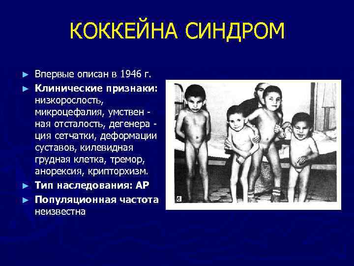 КОККЕЙНА СИНДРОМ ► ► Впервые описан в 1946 г. Клинические признаки: низкорослость, микроцефалия, умствен