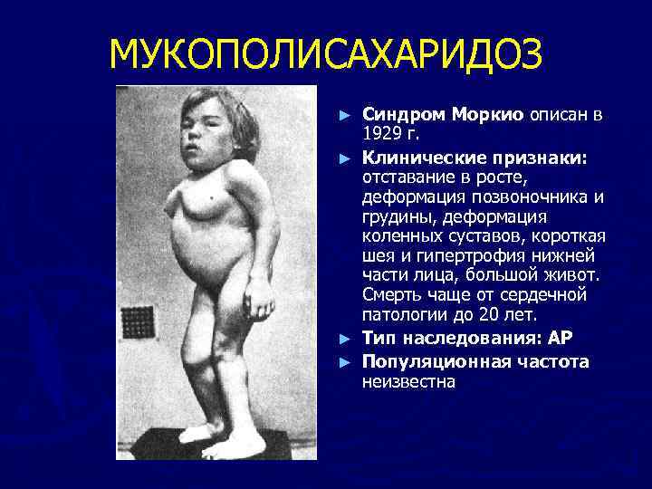 МУКОПОЛИСАХАРИДОЗ ► ► Синдром Моркио описан в 1929 г. Клинические признаки: отставание в росте,
