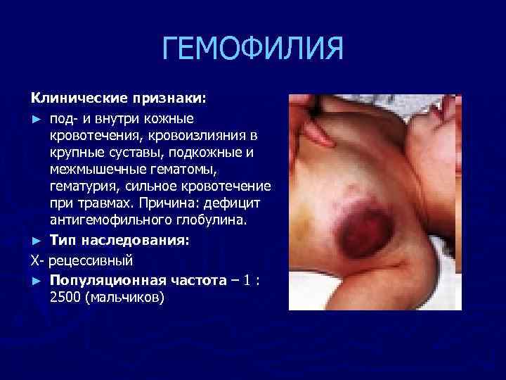 ГЕМОФИЛИЯ Клинические признаки: ► под- и внутри кожные кровотечения, кровоизлияния в крупные суставы, подкожные