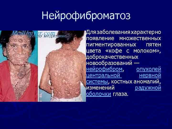 Нейрофиброматоз ► Для заболевания характерно появление множественных пигментированных пятен цвета «кофе с молоком» ,