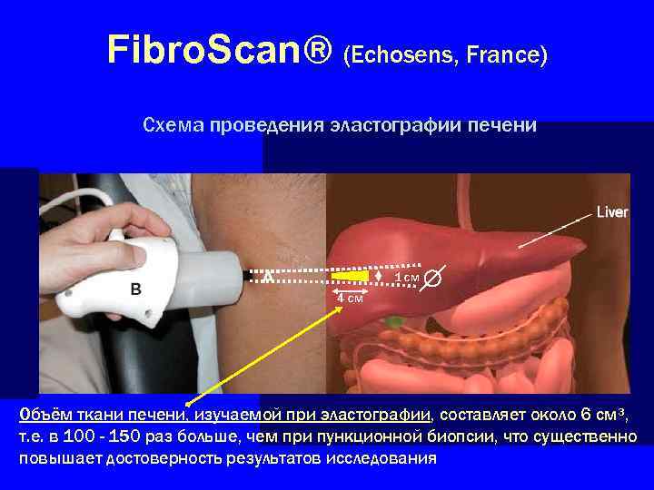 Fibro. Scan® (Echosens, France) Схема проведения эластографии печени 1 см 4 см Объём ткани
