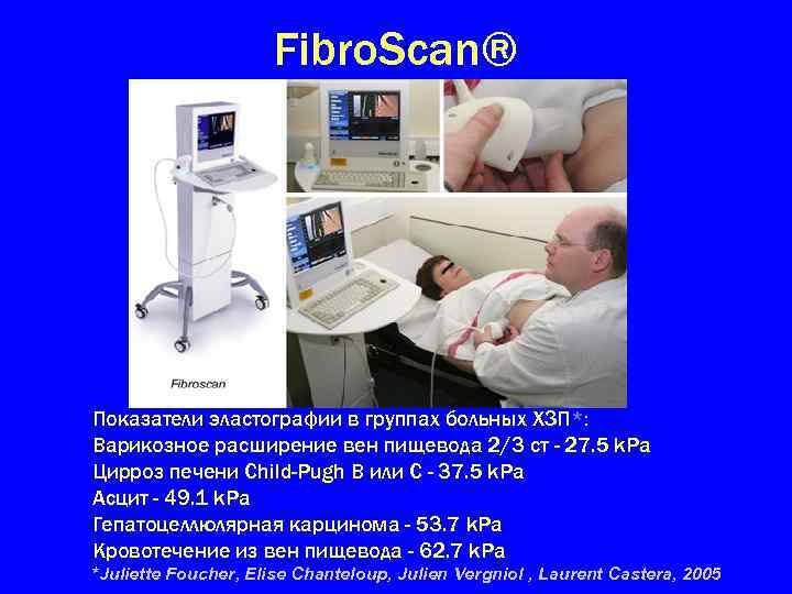 Fibro. Scan® Показатели эластографии в группах больных ХЗП*: Варикозное расширение вен пищевода 2/3 ст