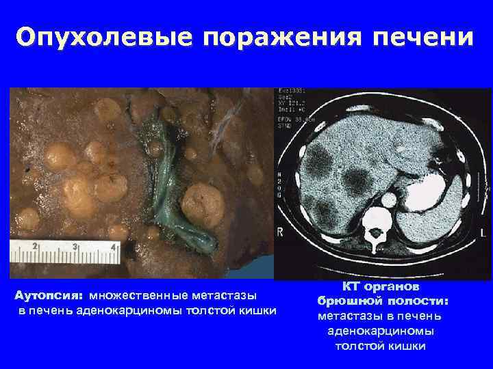 Опухолевые поражения печени Аутопсия: множественные метастазы в печень аденокарциномы толстой кишки КТ органов брюшной