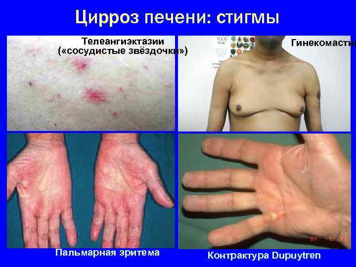 Цирроз печени: стигмы Телеангиэктазии ( «сосудистые звёздочки» ) Пальмарная эритема Гинекомастия Контрактура Dupuytren 