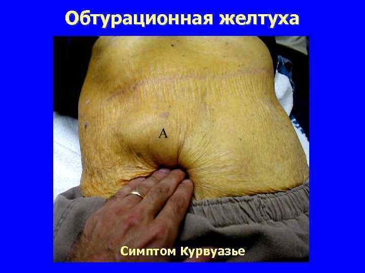 Обтурационная желтуха Симптом Курвуазье 