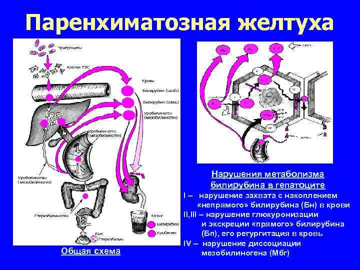 Паренхиматозная желтуха Нарушения метаболизма билирубина в гепатоците Общая схема I – нарушение захвата с