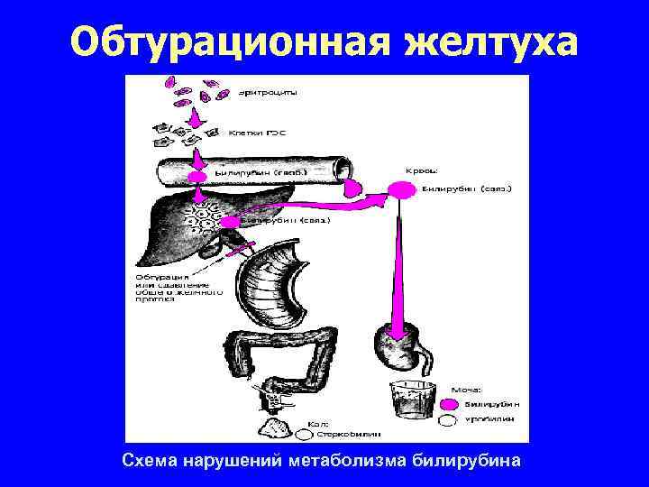 Обтурационная желтуха Схема нарушений метаболизма билирубина 