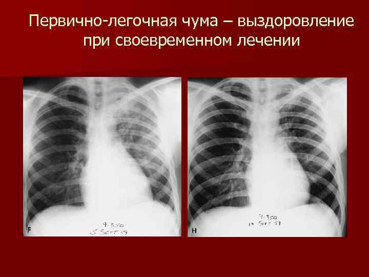 Первично-легочная чума – выздоровление при своевременном лечении 