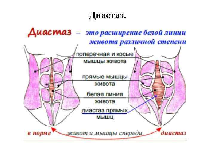 Диастаз. 