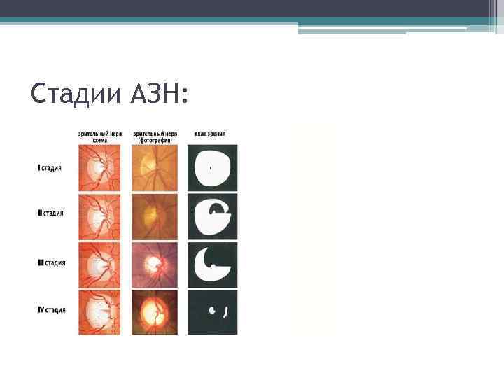 Стадии АЗН: 