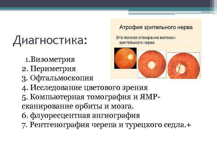 Диагностика: 1. Визометрия 2. Периметрия 3. Офтальмоскопия 4. Исследование цветового зрения 5. Компьютерная томография