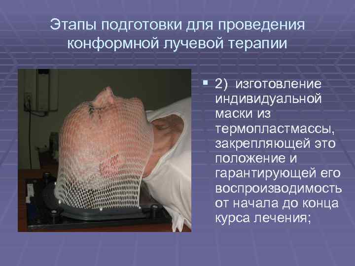 Этапы подготовки для проведения конформной лучевой терапии § 2) изготовление индивидуальной маски из термопластмассы,
