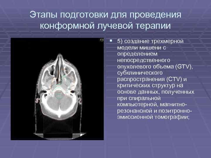 Этапы подготовки для проведения конформной лучевой терапии § 5) создание трехмерной модели мишени с