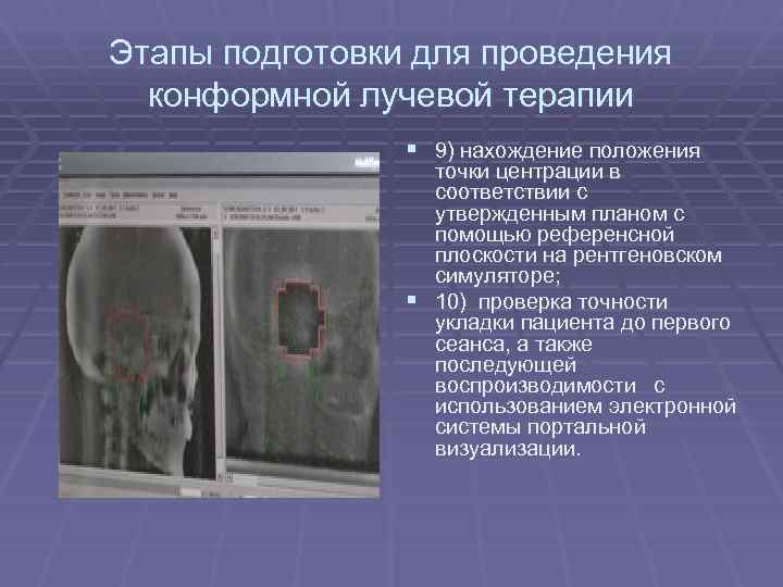 Этапы подготовки для проведения конформной лучевой терапии § 9) нахождение положения точки центрации в