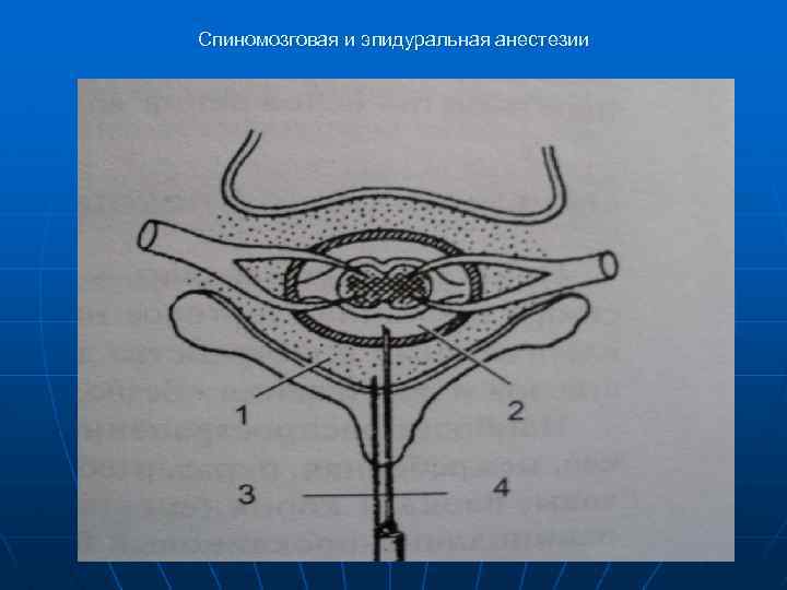 Спиномозговая и эпидуральная анестезии 