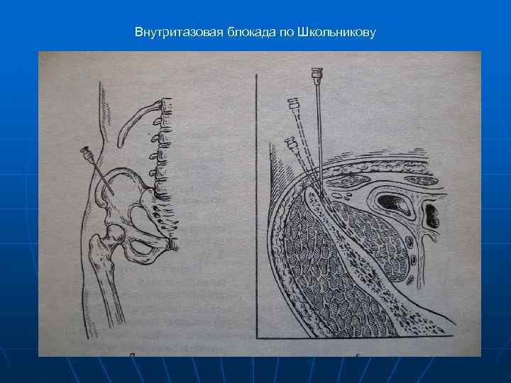 Внутритазовая блокада по Школьникову 