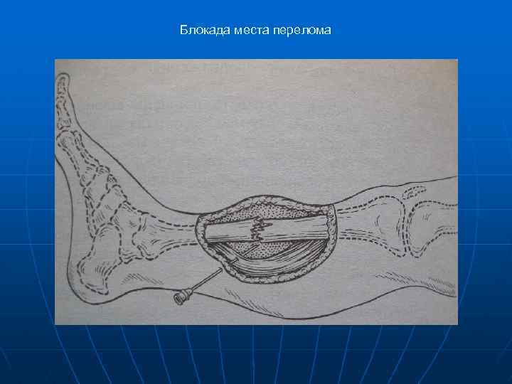 Блокада места перелома 