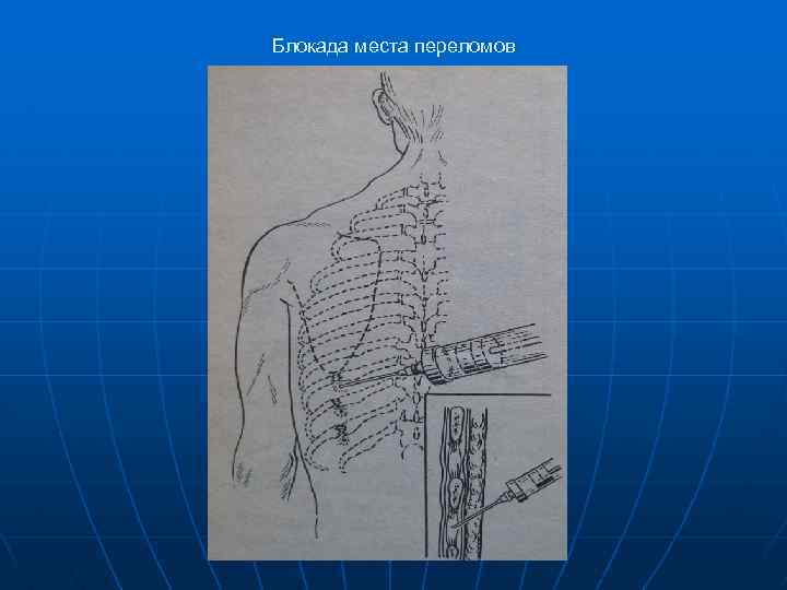 Блокада места переломов 