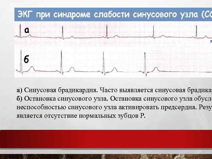 Карта вызова слабость синусового узла