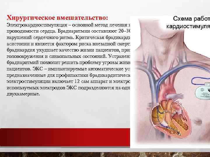 Хирургическое вмешательство: Электрокардиостимуляция – основной метод лечения нарушений проводимости сердца. Брадиаритмии составляют 20– 30%