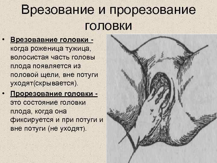 Врезование и прорезование головки • Врезовавние головки когда роженица тужица, волосистая часть головы плода