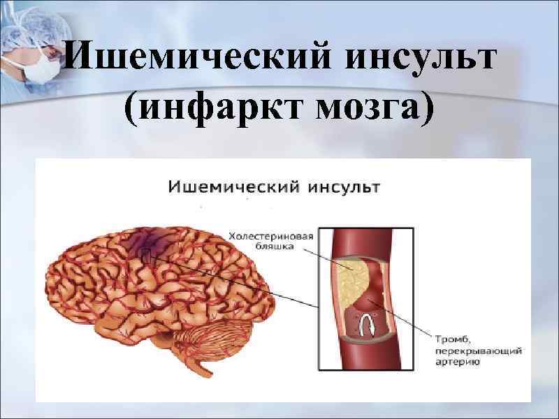 Чем отличается инфаркт. Ишемический инсульт и ишемический инфаркт. Ишемический инсульт мозг. Ишемический инфаркт головного мозга. Инфаркт головного мозга и инсульт.