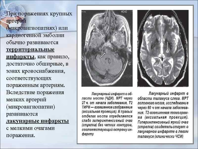 Церебральная микроангиопатия fazekas