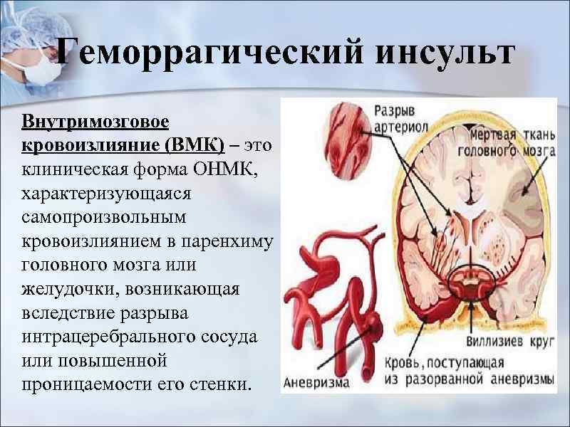 Геморрагический инсульт Внутримозговое кровоизлияние (ВМК) – это клиническая форма ОНМК, характеризующаяся самопроизвольным кровоизлиянием в