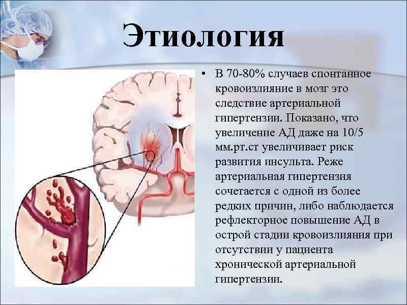 Этиология • В 70 -80% случаев спонтанное кровоизлияние в мозг это следствие артериальной гипертензии.