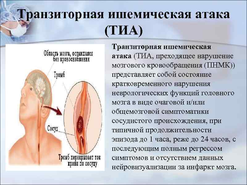 Транзиторная ишемическая атака (ТИА) Транзиторная ишемическая атака (ТИА, преходящее нарушение мозгового кровообращения (ПНМК)) представляет