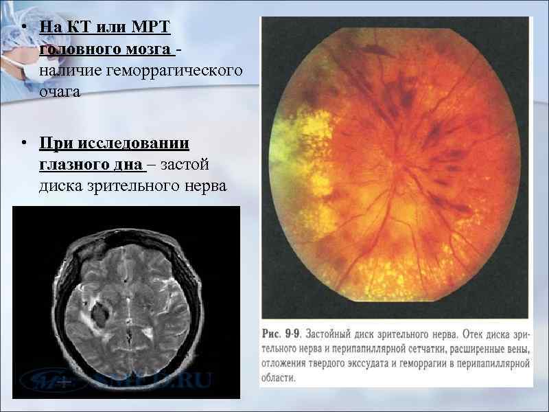  • На КТ или МРТ головного мозга - наличие геморрагического очага • При