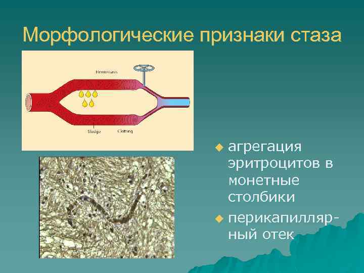 Морфологические признаки стаза агрегация эритроцитов в монетные столбики u перикапиллярный отек u 