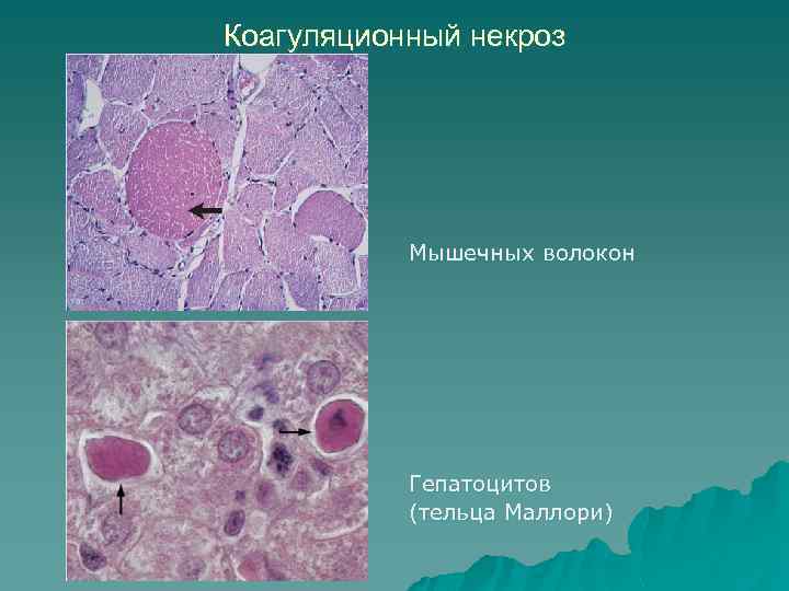 Коагуляционный некроз Мышечных волокон Гепатоцитов (тельца Маллори) 