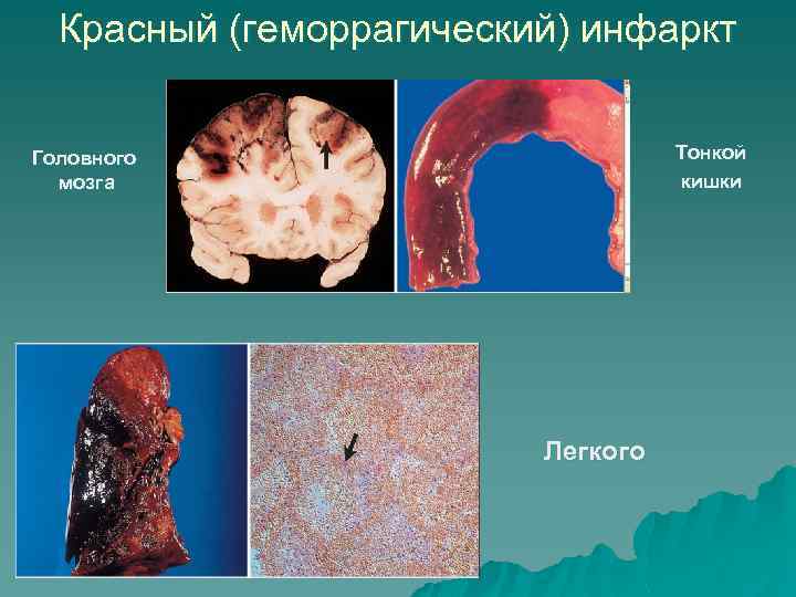 Красный (геморрагический) инфаркт Тонкой кишки Головного мозга Легкого 