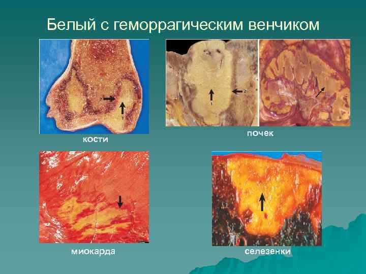 Белый с геморрагическим венчиком кости миокарда почек селезенки 