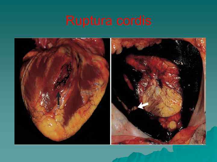 Ruptura cordis 