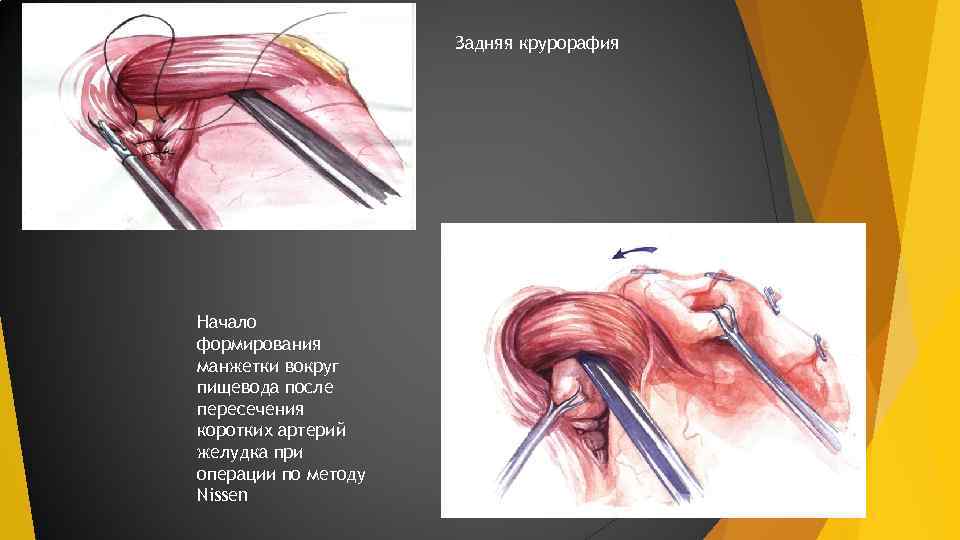 Задняя крурорафия Начало формирования манжетки вокруг пищевода после пересечения коротких артерий желудка при операции