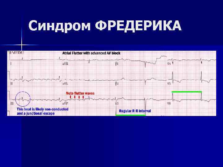Синдром ФРЕДЕРИКА 